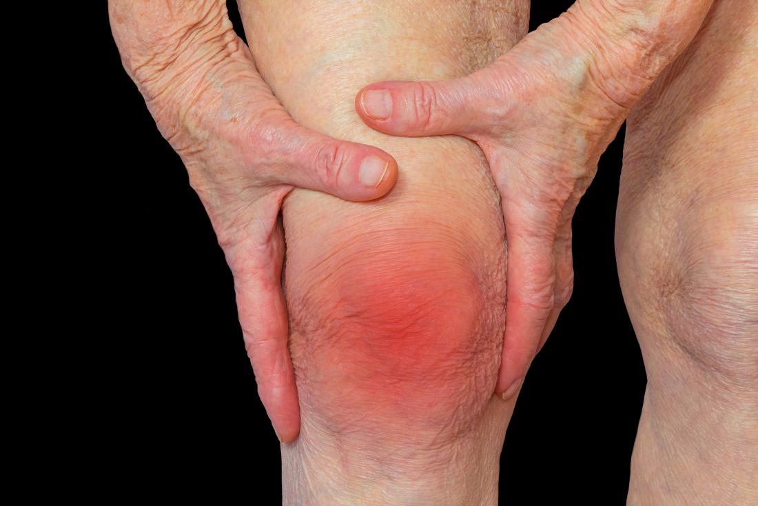 https://recovapro.de/cdn/shop/articles/rheumatoid-arthritis-knee_874ee991-047d-48c3-8a15-0cddab9d8257_1600x.jpg?v=1661755539